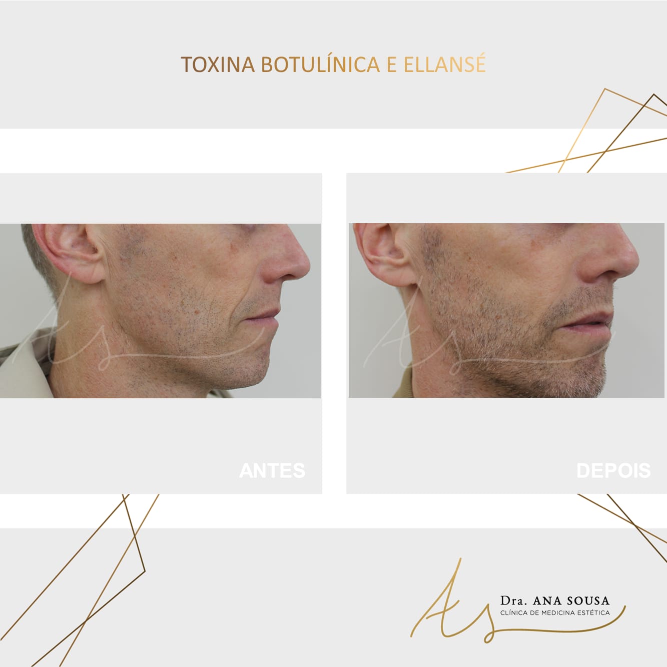 Toxina Botul&iacute;nica