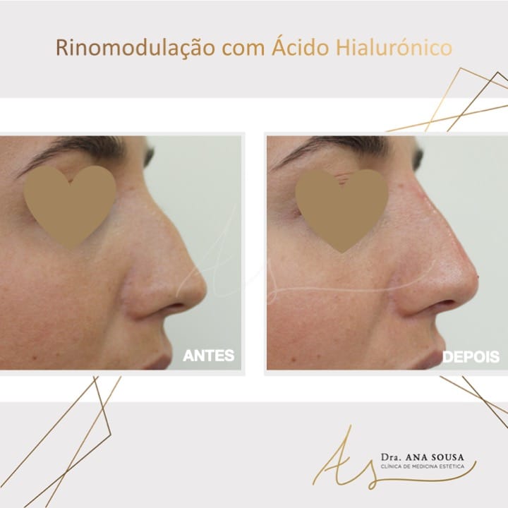 acido hialuronico 7 ÁCIDO HIALURÓNICO