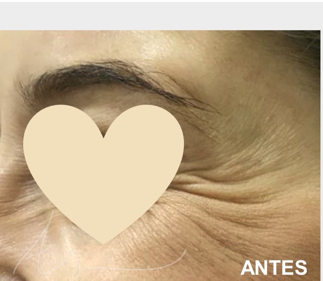 botox antes 2 Botox,toxina botulínica