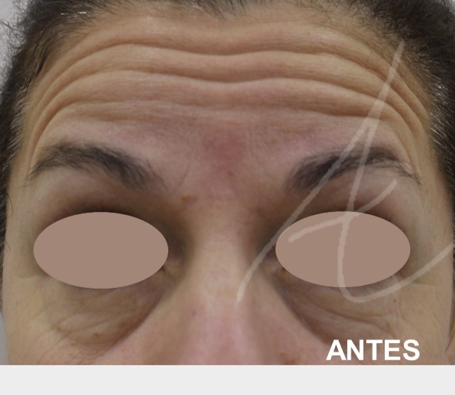 botox antes 3 Botox,toxina botulínica