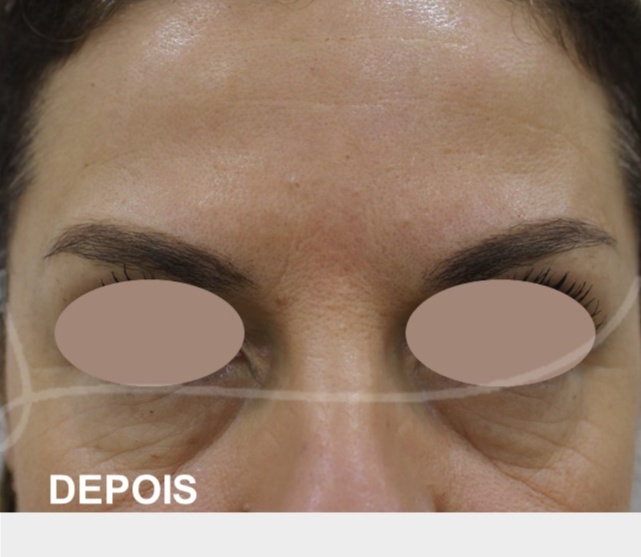 botox depois 1 Botox,toxina botulínica