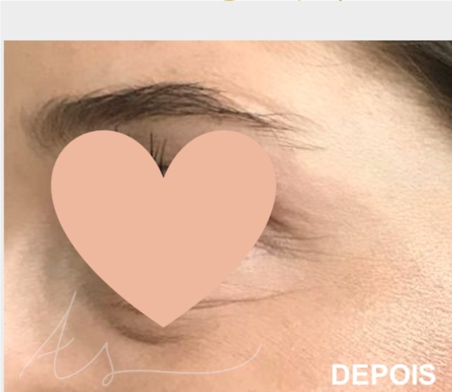 botox depois 3 Botox,toxina botulínica