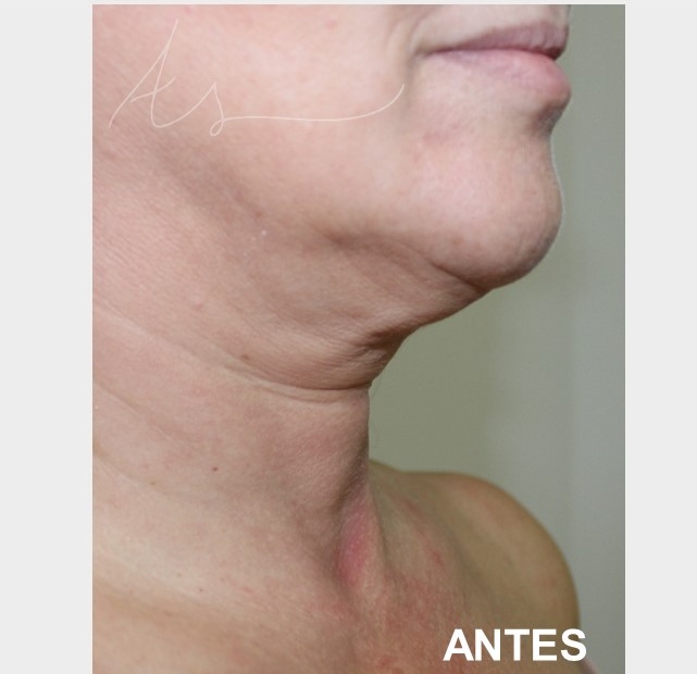Rejuvenescimento Facial,Morpheus8,Laser Co2 fracionado,Luz intensa pulsada (IPL),Radiofrequ&ecirc;ncia Monopolar