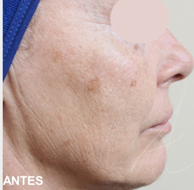 Rejuvenescimento Facial,Morpheus8,Laser Co2 fracionado,Luz intensa pulsada (IPL),Radiofrequ&ecirc;ncia Monopolar