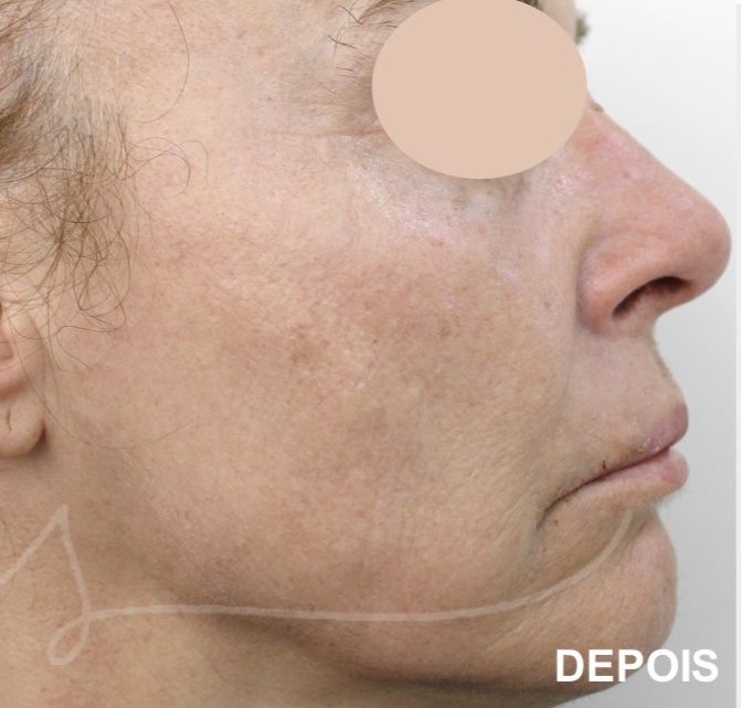 Rejuvenescimento Facial,Morpheus8,Laser Co2 fracionado,Luz intensa pulsada (IPL),Radiofrequ&ecirc;ncia Monopolar