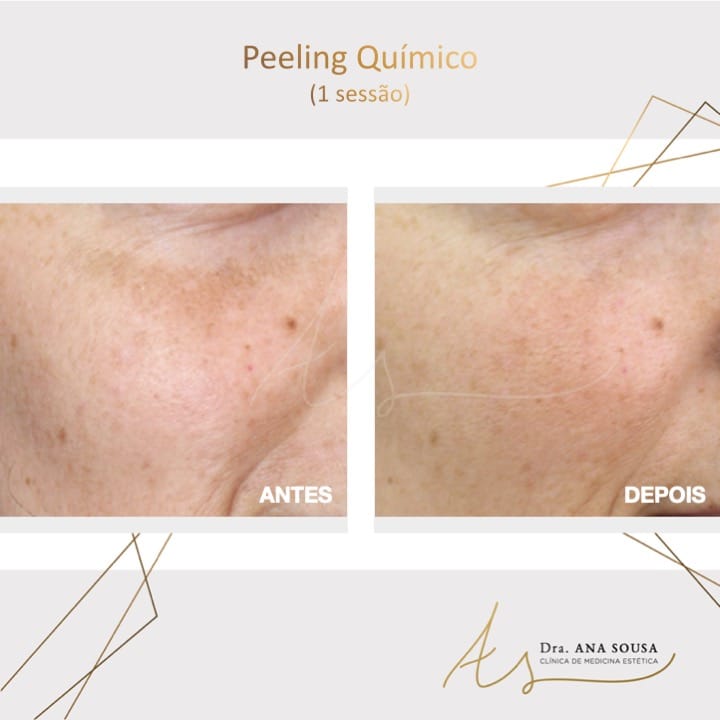 Peeling Qu&iacute;mico