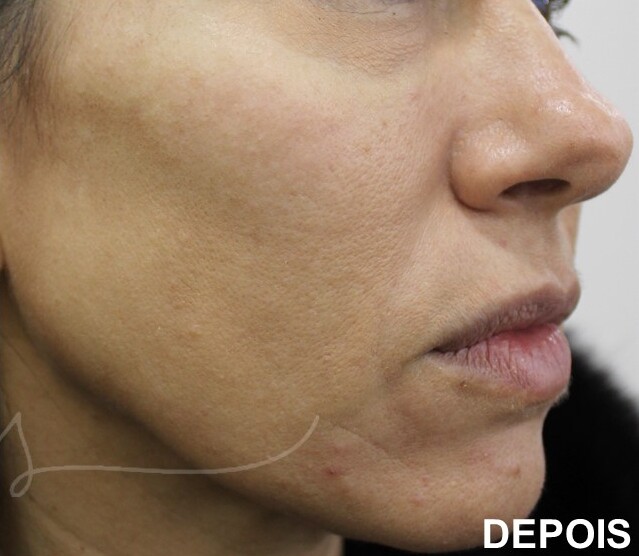 Rejuvenescimento Facial,Morpheus8,Laser Co2 fracionado,Luz intensa pulsada (IPL),Radiofrequ&ecirc;ncia Monopolar
