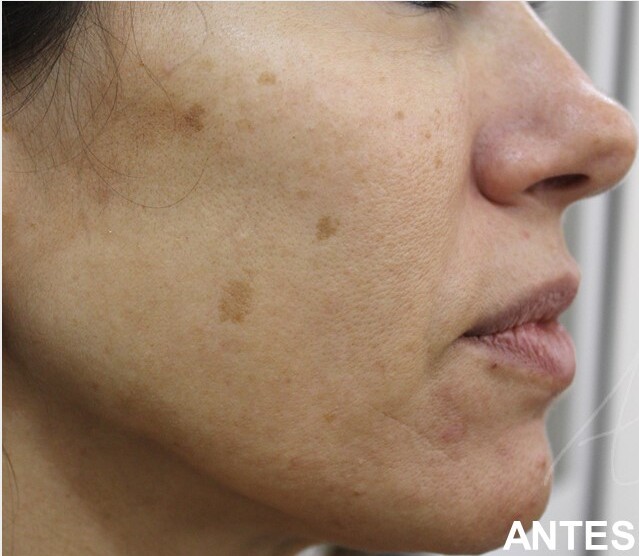 Rejuvenescimento Facial,Morpheus8,Laser Co2 fracionado,Luz intensa pulsada (IPL),Radiofrequ&ecirc;ncia Monopolar