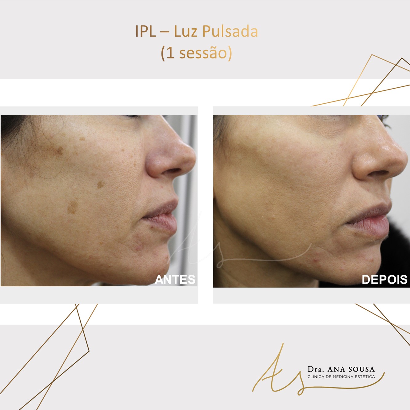 Luz pulsada,ipl