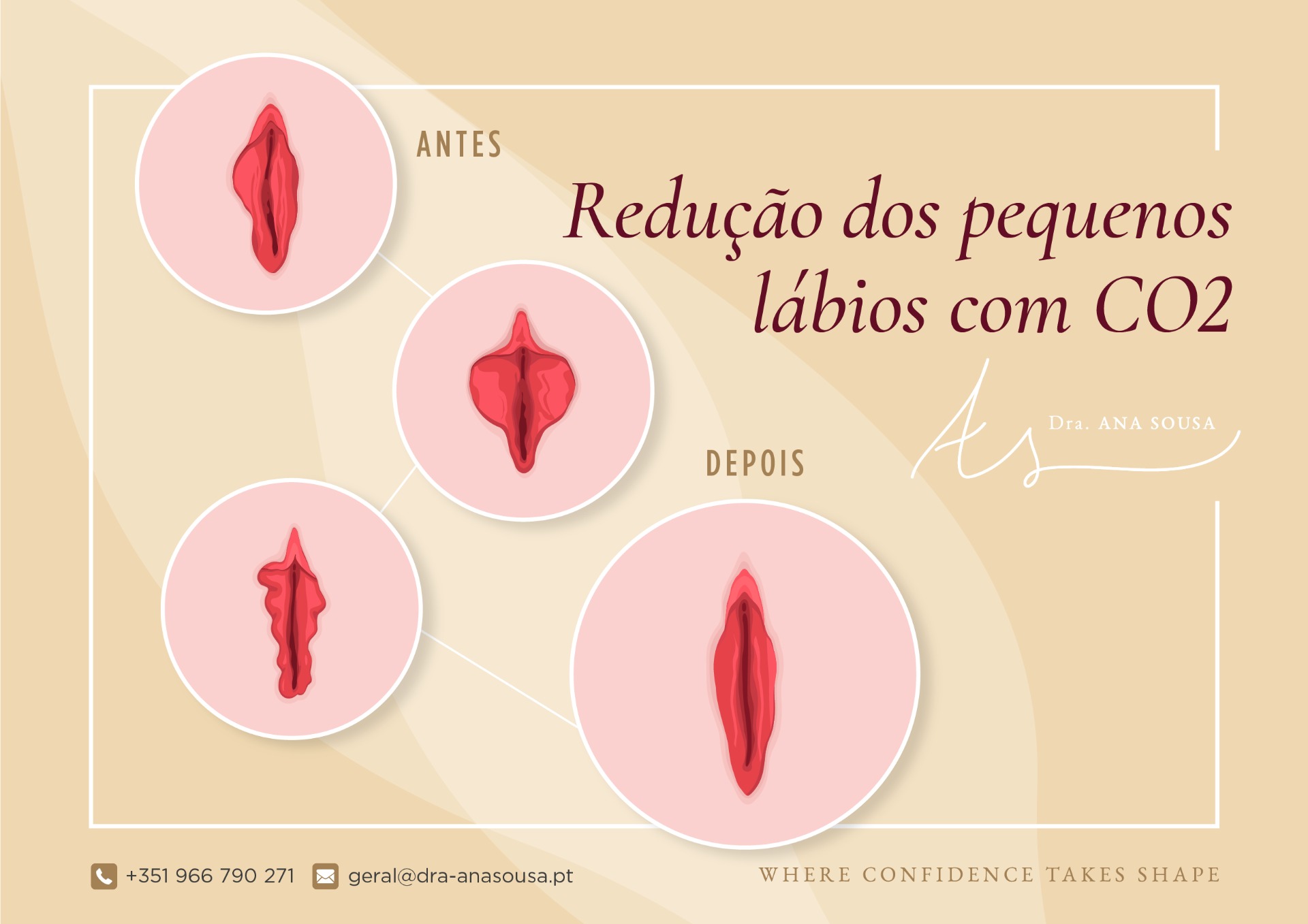 labioplastia Rejuvenescimento íntimo,Rejuvenescimento intimo,rejuvenescimento intimo a laser preço
