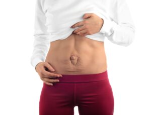 diastase abdominal diástase abdominal dra ana sousa