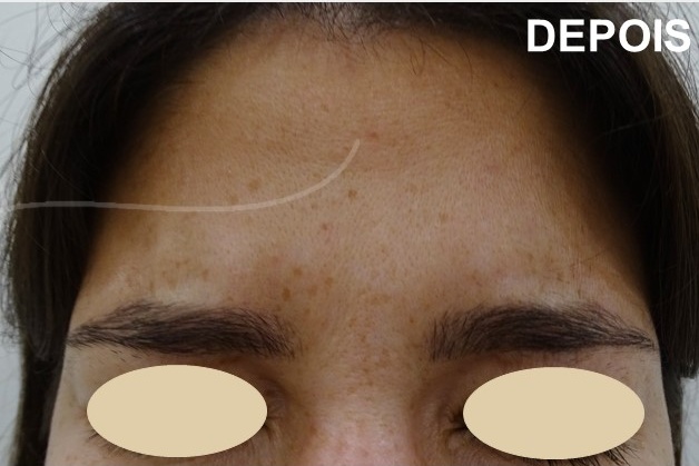 aplicacao botox dra ana sousa depois 1 toxina botulinica