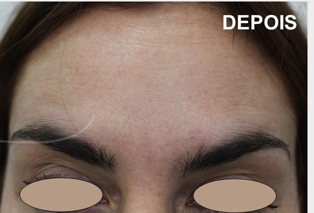 aplicacao botox dra ana sousa depois 2 toxina botulinica