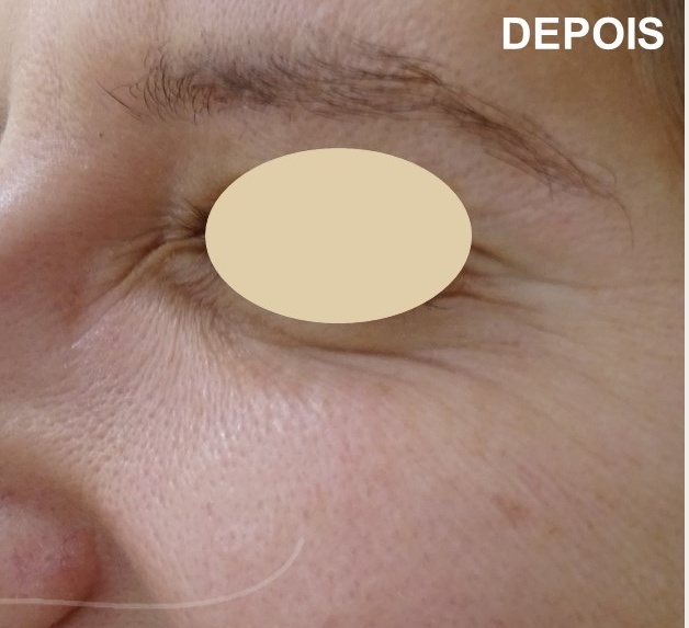 aplicacao botox dra ana sousa depois 3 toxina botulinica