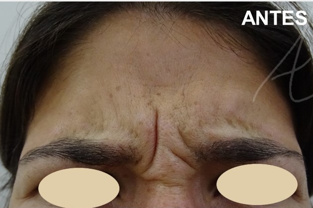 botox dra ana sousa antes 1 toxina botulinica