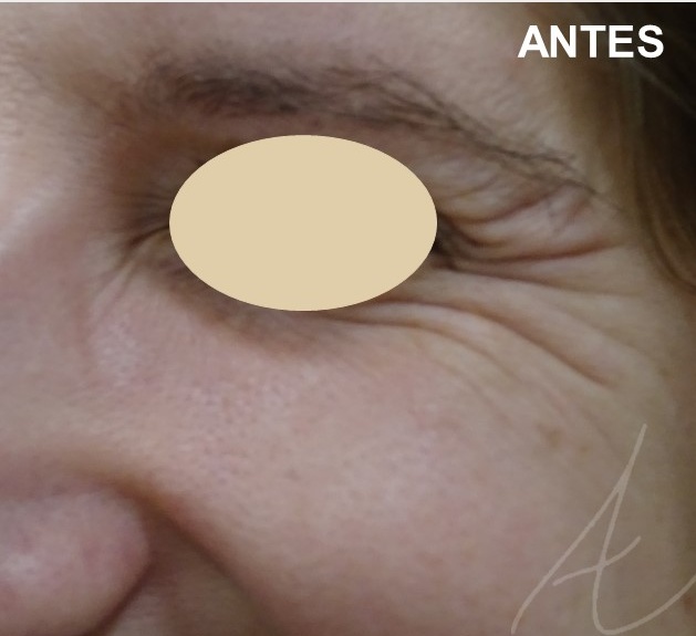 botox dra ana sousa antes 3 toxina botulinica