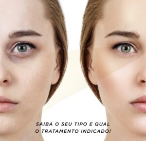como eliminar olheiras - dra ana sousa