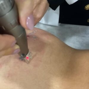 remoção de tatuagem a laser