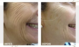 bioestimuladores de colagenio antes e depois bioestimuladores de colagénio antes e depois