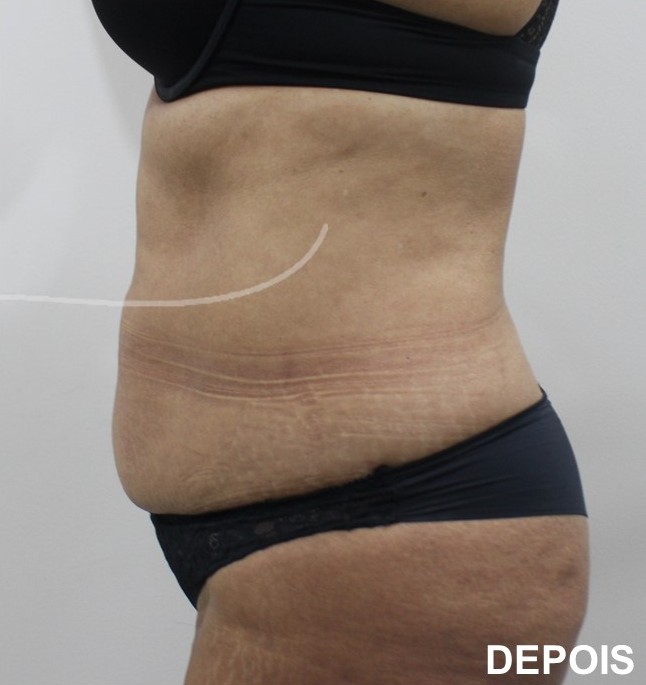 criolipolise depois 4 Criolipólise,gordura localizada