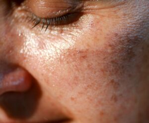 cuidar da pele apos o verao 1 cuidar da pele após o verão