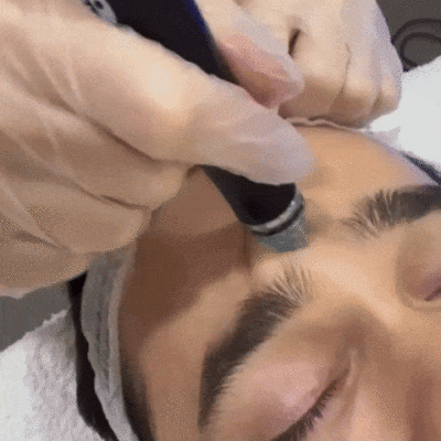 WhatsAppVideo2024 04 09at10.24.15 ezgif.com optimize tratamentos faciais - Hydrafacial dra. ana sousa