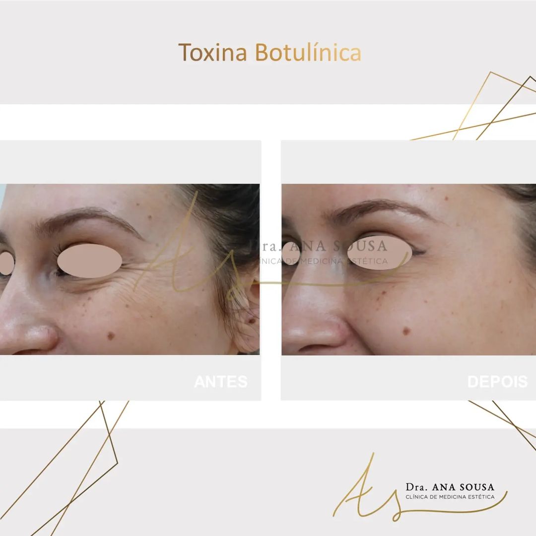 Toxina Botul&iacute;nica