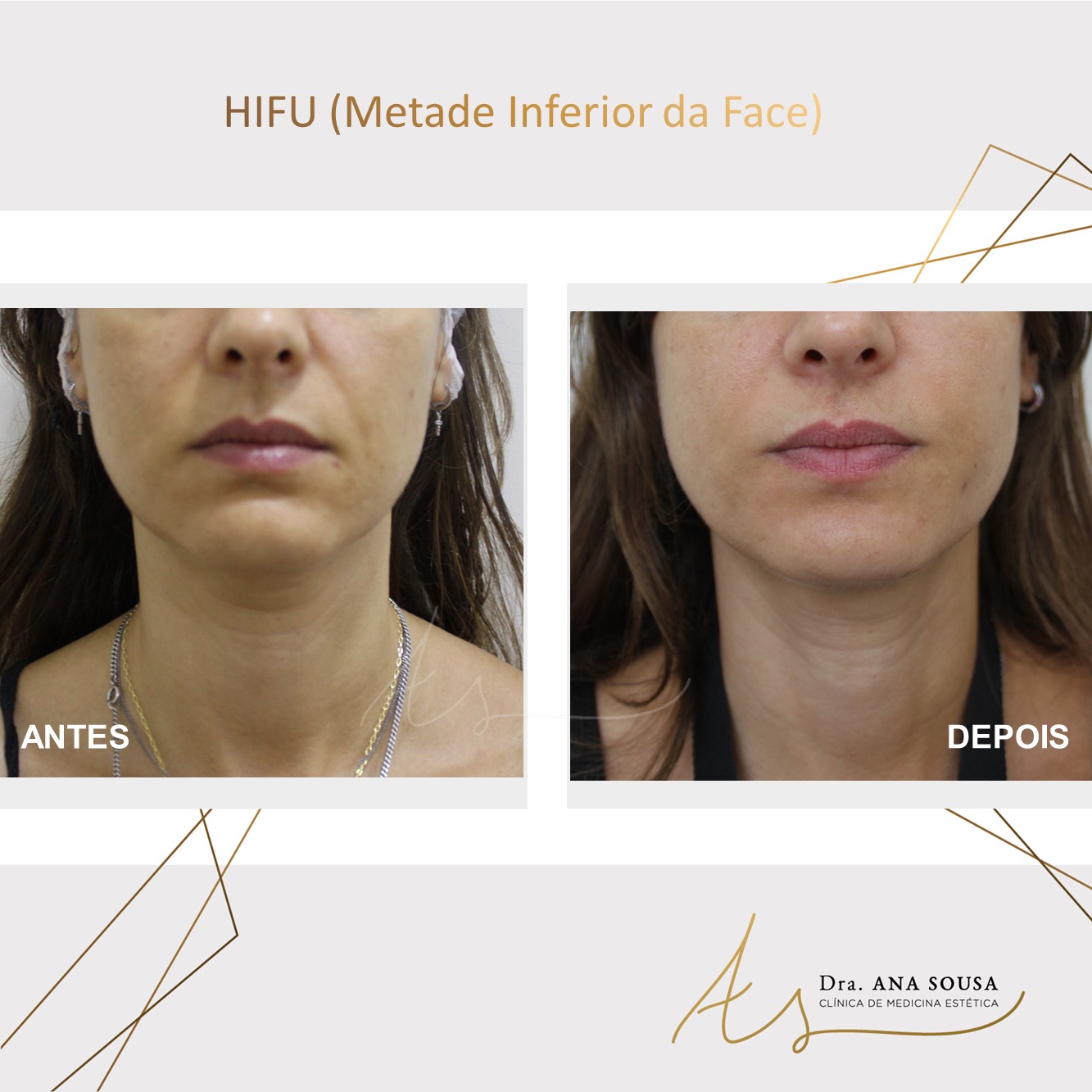hifu