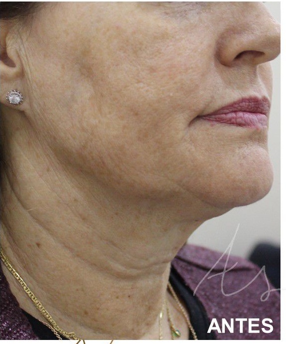 HIFU,Ultrassom microfocado