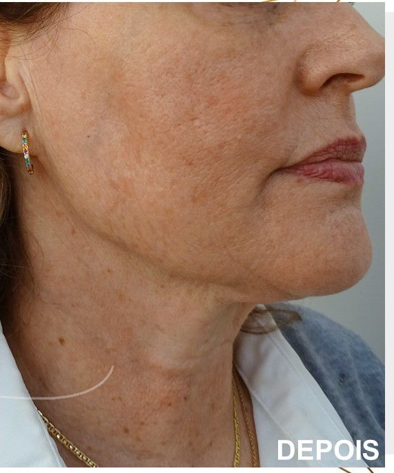 HIFU Tratamento da papada duplo queixo 1 2 HIFU,Ultrassom microfocado