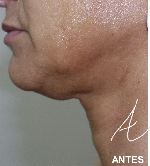 HIFU,Ultrassom microfocado