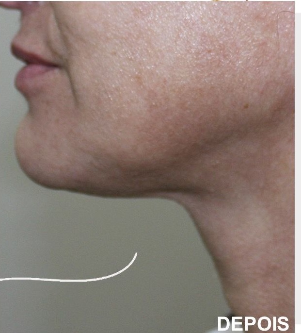 HIFU Tratamento da papada duplo queixo 3 2 HIFU,Ultrassom microfocado