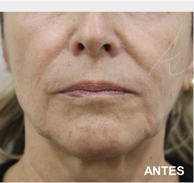 HIFU,Ultrassom microfocado