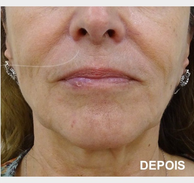 HIFU Tratamento da papada duplo queixo 4 3 HIFU,Ultrassom microfocado