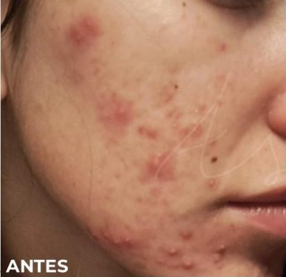 tratamento remoção de marcas de acne - antes