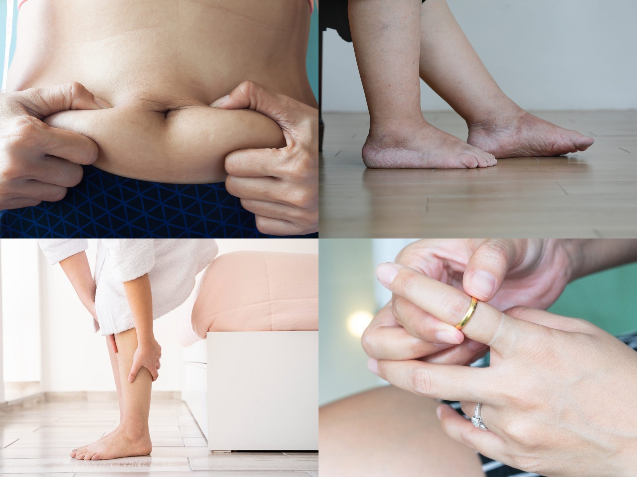retencao de liquidos 1 scaled medicina estética,TRATAMENTOS DE CORPO,TRATAMENTOS FACIAIS