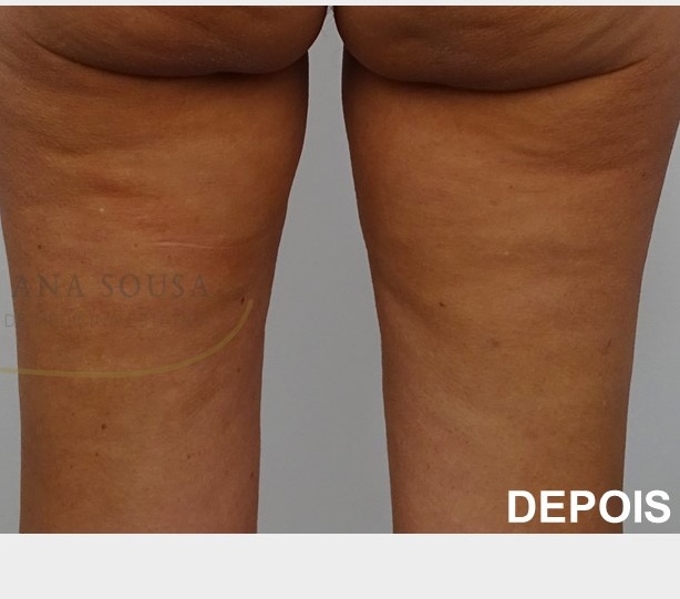 emtone depois celulite