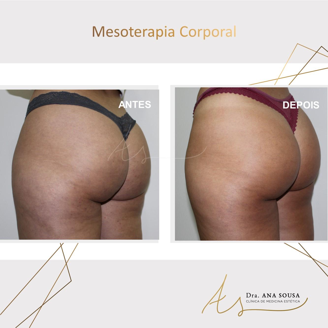 MESOTERAPIA