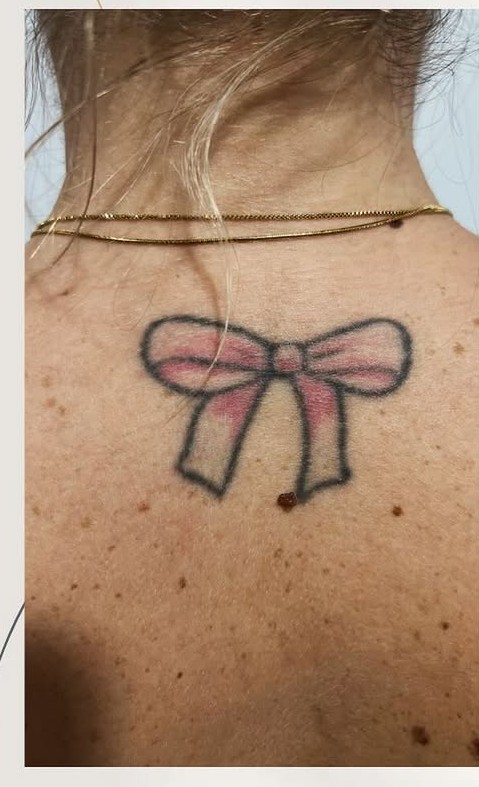 remo&ccedil;&atilde;o de tatuagem
