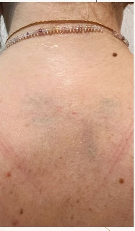 remo&ccedil;&atilde;o de tatuagem